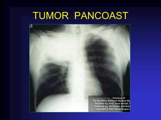 TUMOR PANCOAST
 