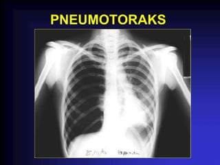 PNEUMOTORAKS
 