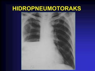 HIDROPNEUMOTORAKS
 
