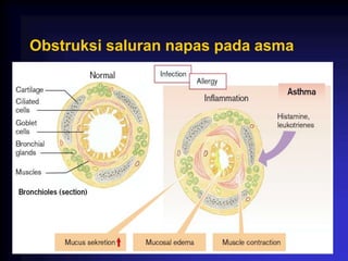 Obstruksi saluran napas pada asma
 