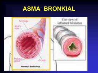 ASMA BRONKIAL
 