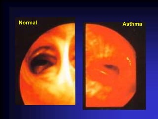 Asthma
Normal
 