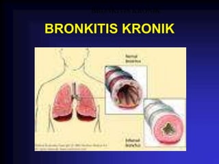 BRONKITIS KRONIK
BRONKITIS KRONIK
 