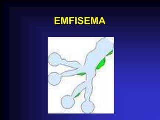 EMFISEMA
 