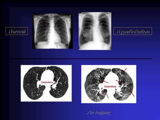 Normal Hyperinflation
Air trapping
 