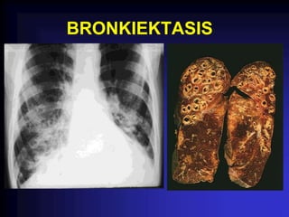 BRONKIEKTASIS
 