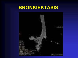 BRONKIEKTASIS
 