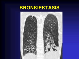 BRONKIEKTASIS
 