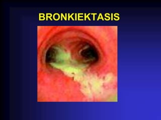 BRONKIEKTASIS
 