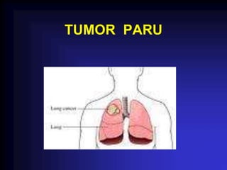 TUMOR PARU
 