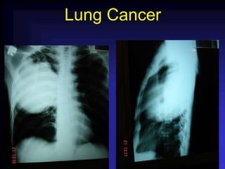 Lung Cancer
 
