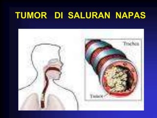 TUMOR DI SALURAN NAPAS
 