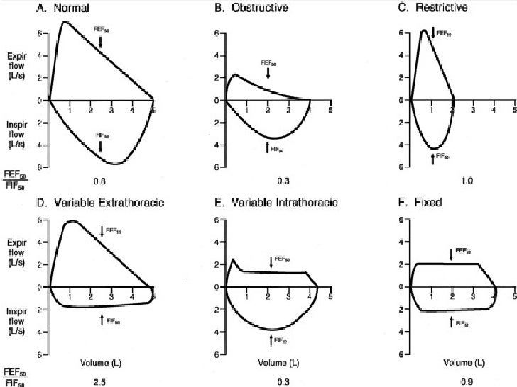 Spirometry