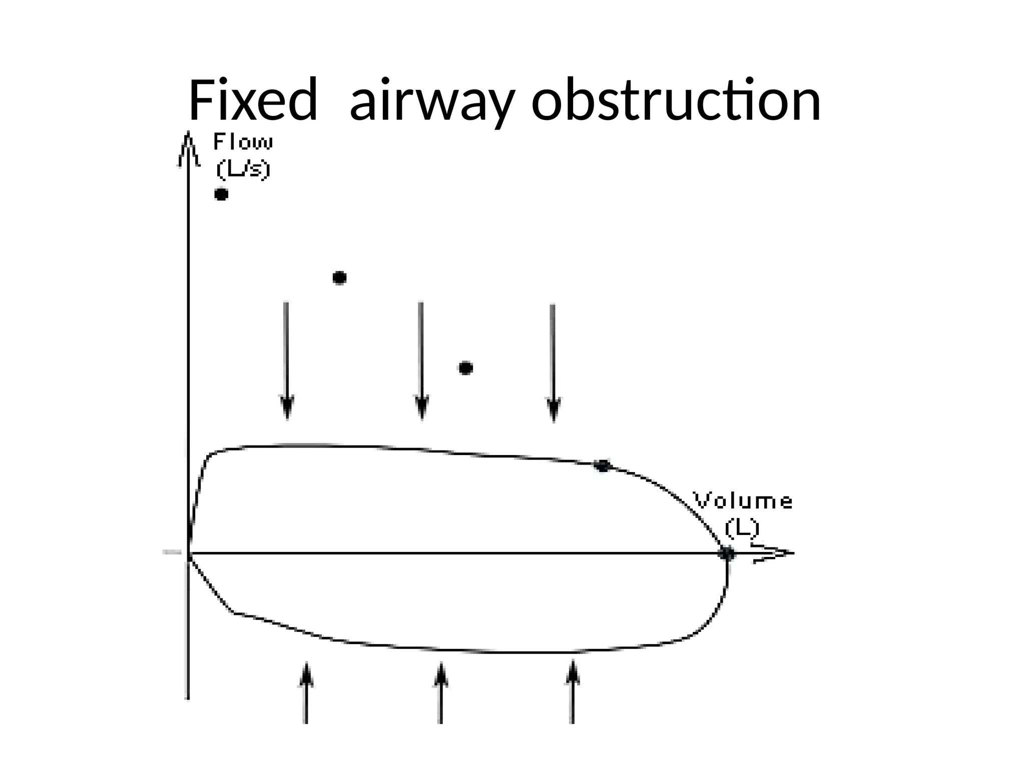 Fixed airway obstruction
 