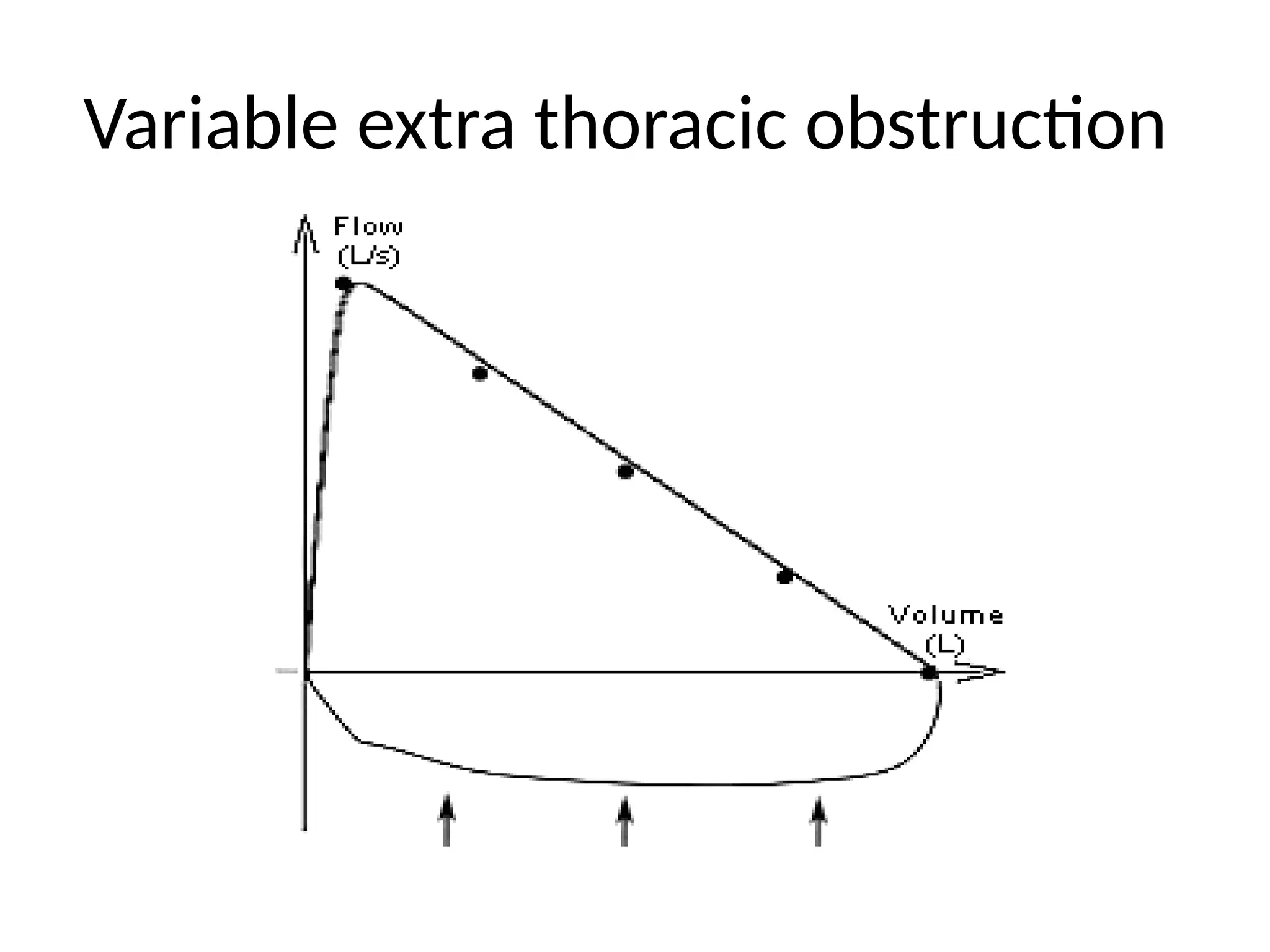 Variable extra thoracic obstruction
 