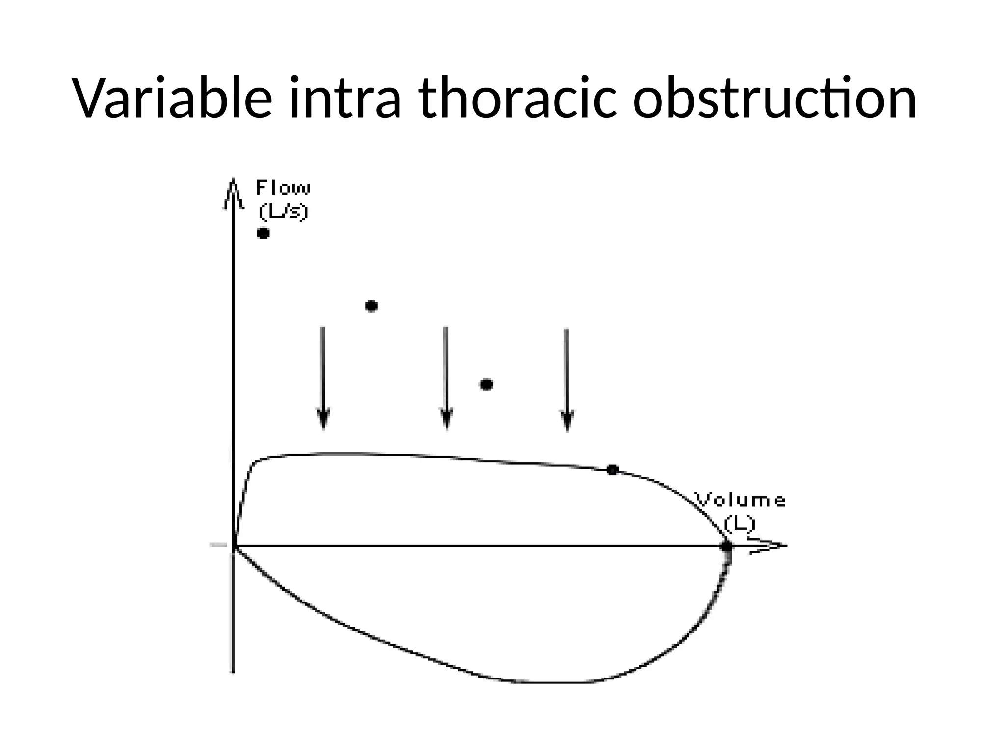 Variable intra thoracic obstruction
 