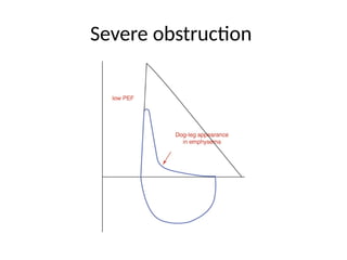 Severe obstruction
 