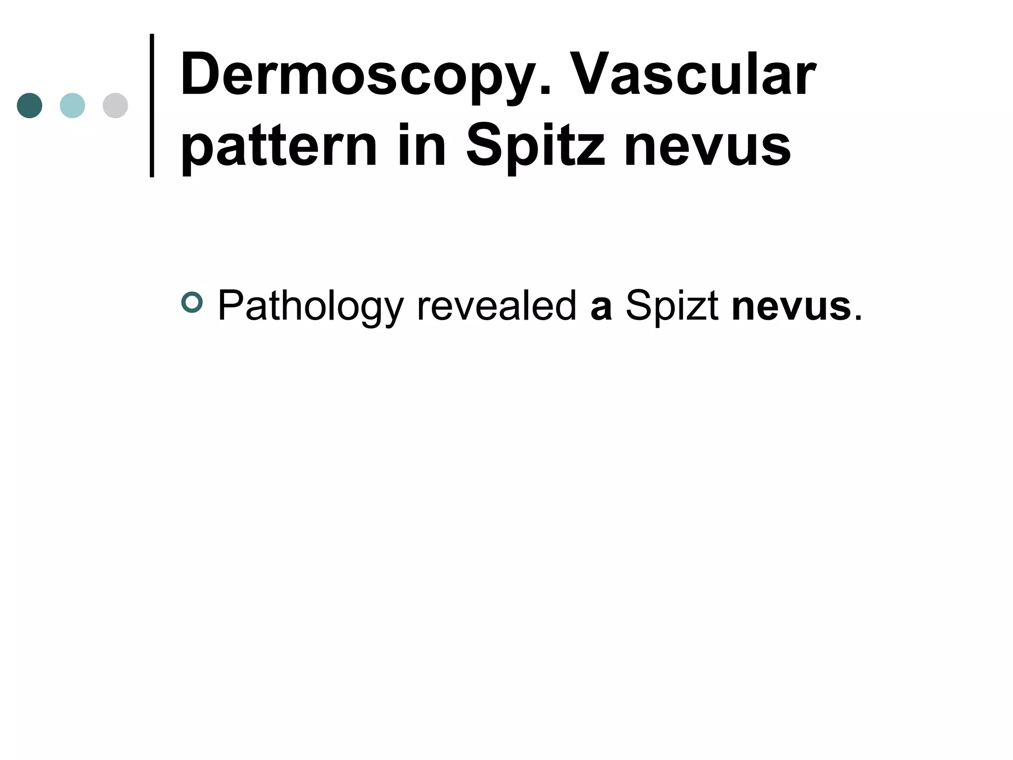 Spitz nevus | PPT