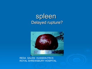 spleen Delayed rupture? REDA  SALEM  HUSSEIN.FRCS ROYAL SHREWSBURY HOSPITAL 