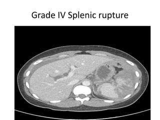 Grade IV Splenic rupture
 