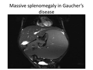 Massive splenomegaly in Gaucher’s
disease
 