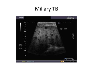 Miliary TB
 