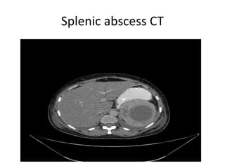 Splenic abscess CT
 