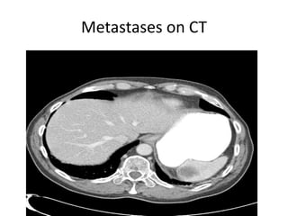 Metastases on CT
 