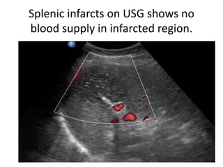 Splenic infarcts on USG shows no
blood supply in infarcted region.
 