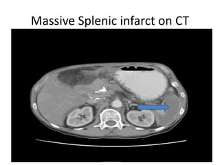 Massive Splenic infarct on CT
 