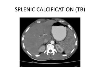SPLENIC CALCIFICATION (TB)
 