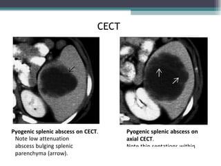 Spleen in surgery | PPT