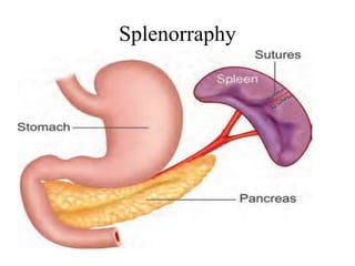 Spllenic Rupture splenic injury | PPTX