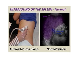 Spolon Radiography Spleen Ultrasound anatomy structure scanning techniques and pathologies ...