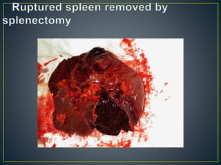 Spleen anatomy