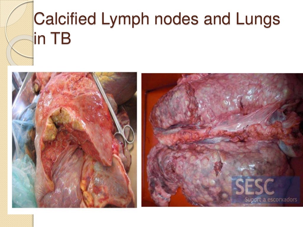 Spleen And Lymph Nodes