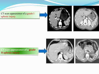 Spleenectomy | PPTX