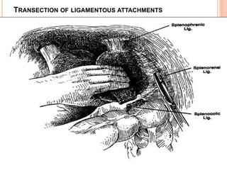 TRANSECTION OF LIGAMENTOUS ATTACHMENTS
 