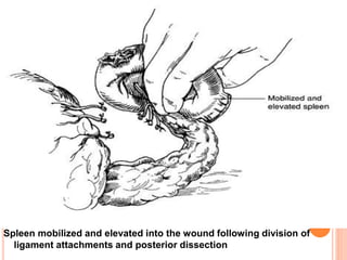 Spleen mobilized and elevated into the wound following division of
ligament attachments and posterior dissection
 