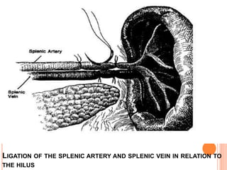 LIGATION OF THE SPLENIC ARTERY AND SPLENIC VEIN IN RELATION TO
THE HILUS
 