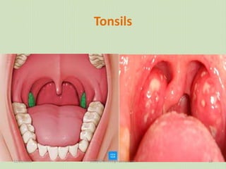 Tonsils
12/25/2018 studyforum911@hotmail.com 13
 