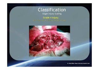 Spleen Trauma Classification