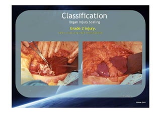 Spleen Trauma Classification