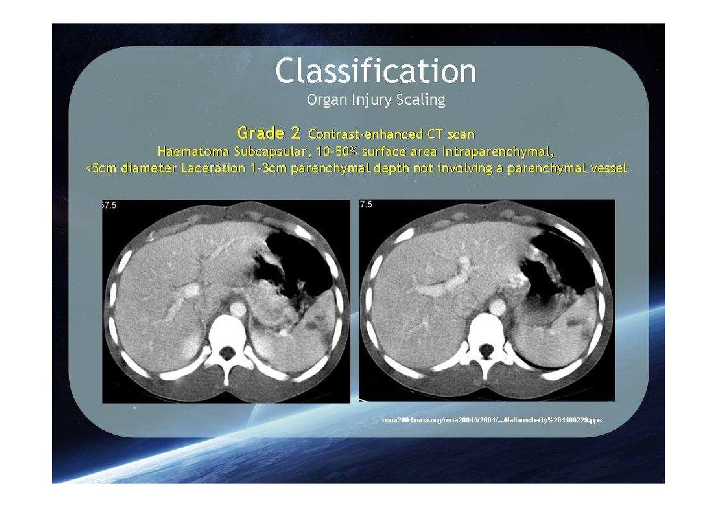 Spleen trauma classification