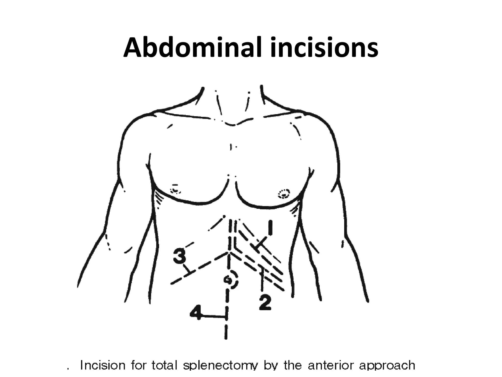Splenectomized Patient pre and post operative management of paediatric Splenectomy patients | PPTX
