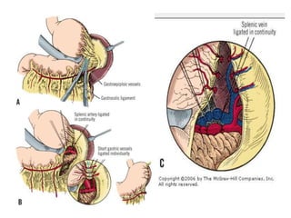 Splenectomized Patient pre and post operative management of paediatric Splenectomy patients | PPTX