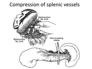 Splenectomized Patient pre and post operative management of paediatric Splenectomy patients | PPTX