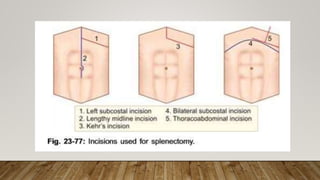 Splenectomy Changes Splenectomy | PPTX
