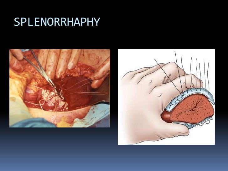 2 absorbable suture Splenic injuries 2 absorbable suture Splenic injuries