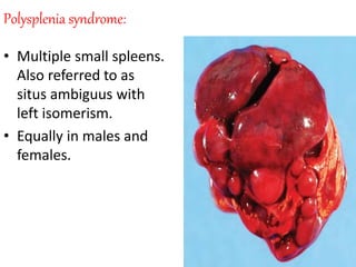 Polysplenia syndrome:
• Multiple small spleens.
Also referred to as
situs ambiguus with
left isomerism.
• Equally in males and
females.
 